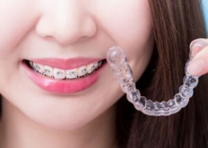Common Dental Misalignments and How to Fix Them without Braces